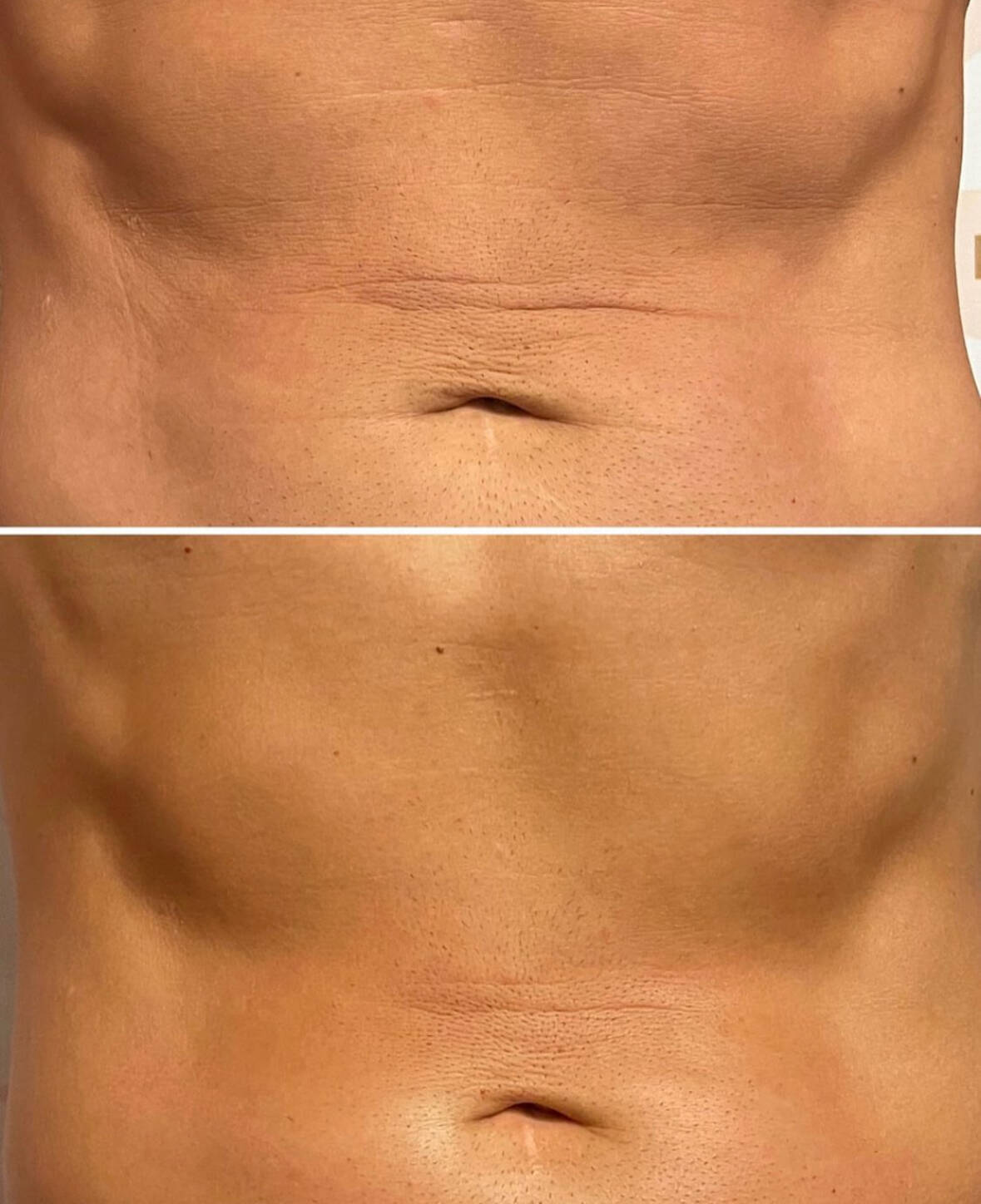 Ultrasound Cavitation Body Sculpting Treatments in Haywards Heath -  Blissimo Beauty Therapy
